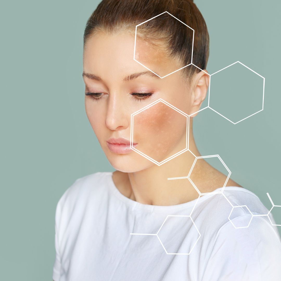 L'acné et l'intolérance à l’histamine Naturel Acné Solution